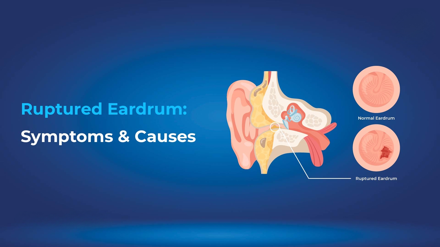 Ruptured Eardrum Symptoms and Causes