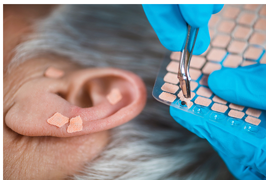 Ear Acupuncture: Tiny Needles, Big Benefits