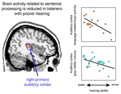 hearing-loss-audicus-brain