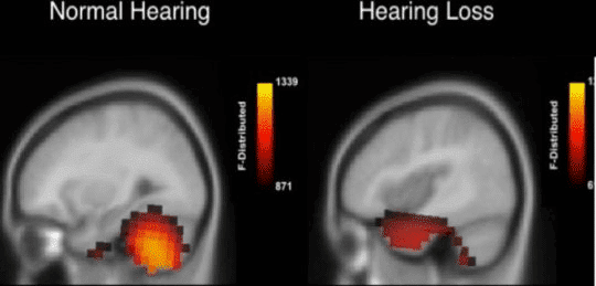 cognitive - shifts - hearing - loss - aids - brain