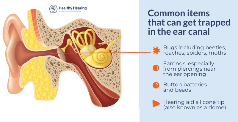 Common items that can get trapped in ears include earrings, beads, toys, and food. 