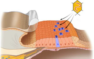 hearing-loss-audicus-cure
