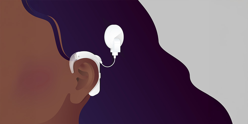 A Comprehensive Guide to Cochlear Implants for Profound Heari